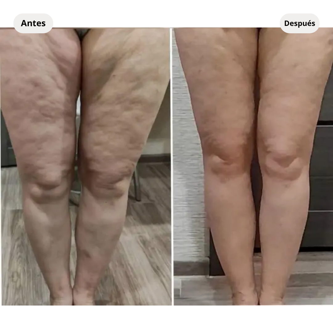 AUVEREA Firmeza 360™ | Dispositivo corporal 3 en 1