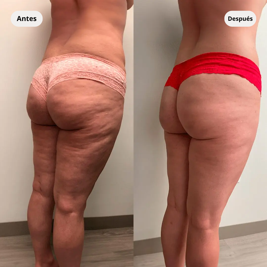 AUVEREA Firmeza 360™ | Dispositivo corporal 3 en 1